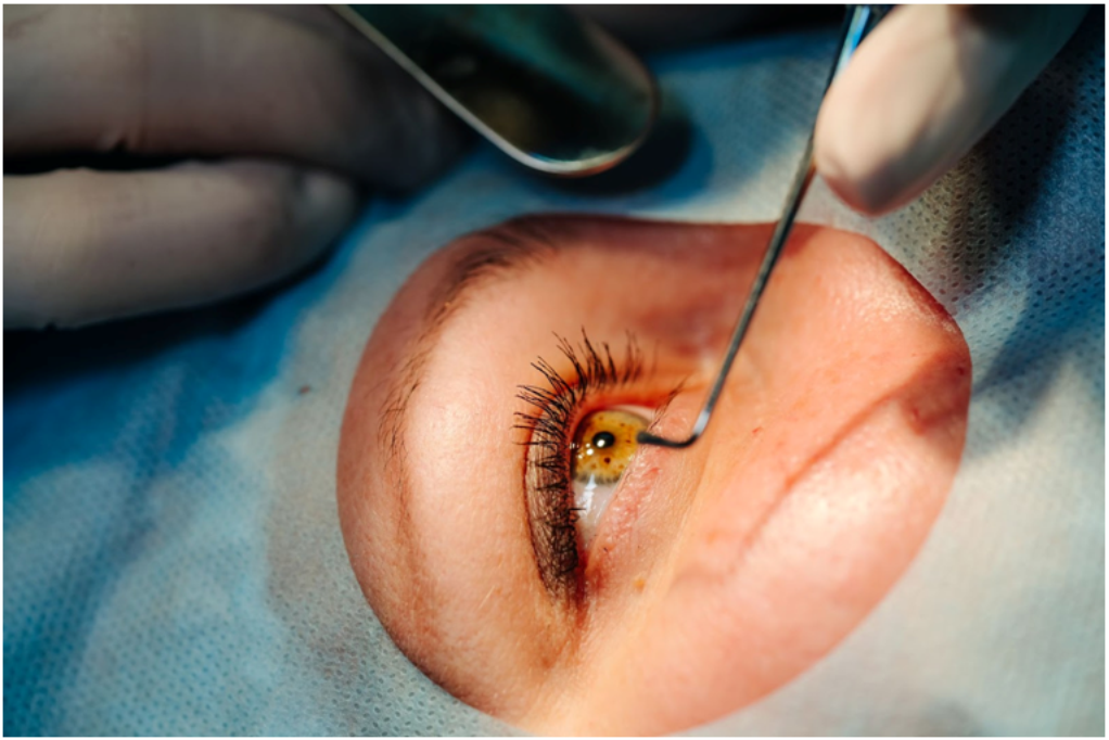 5 mitos comuns sobre a cirurgia de catarata