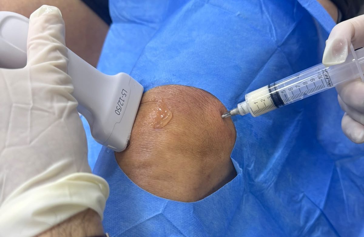 Tratamento com PRP, eficaz para aliviar a dor da artrose, passa a ser regulamentado no Brasil
